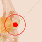 Dolor en la rodilla debido a la tendinopatía rotuliana, también conocida como "rodilla del saltador", destacando la ubicación específica de la afección en el tendón rotuliano.